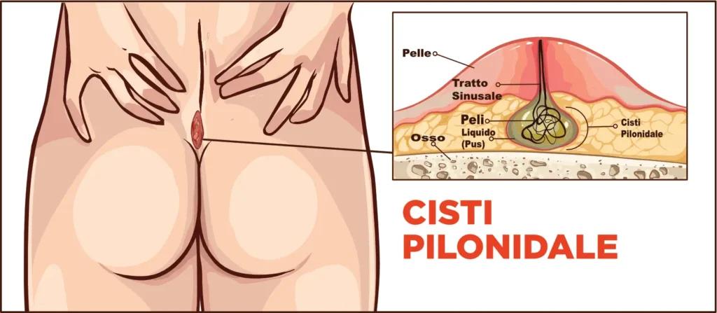 Cisti Pilonidale Anatomia