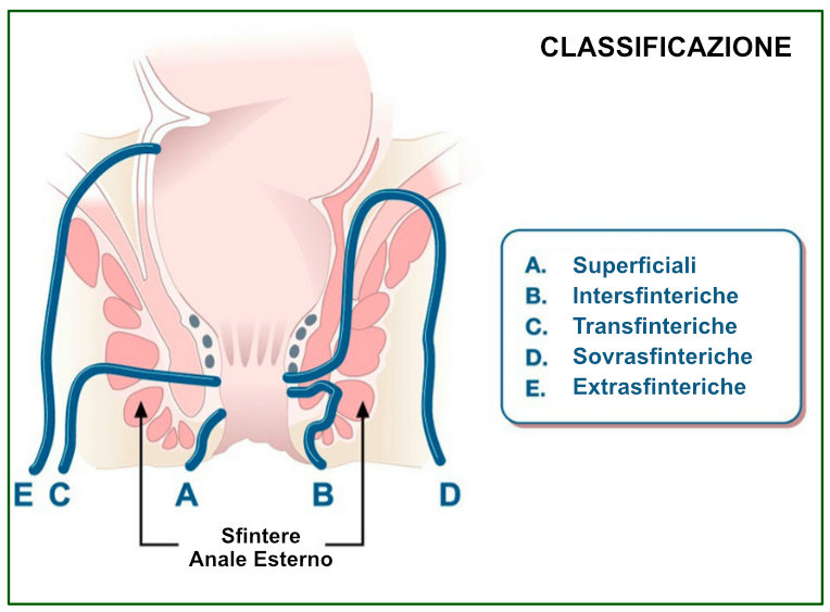 Classificazione Fistole Perianali